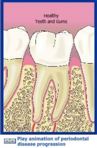 牙周病治療解釋圖